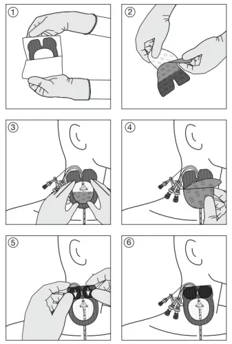 Curafix i.v. Control (9 x 11 cm) steril kontrollablakos centrálvénás kanülrögzítő tapasz