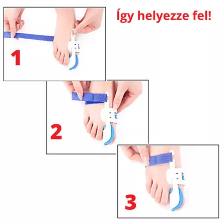 Éjszakai bütyökkorrigáló sín